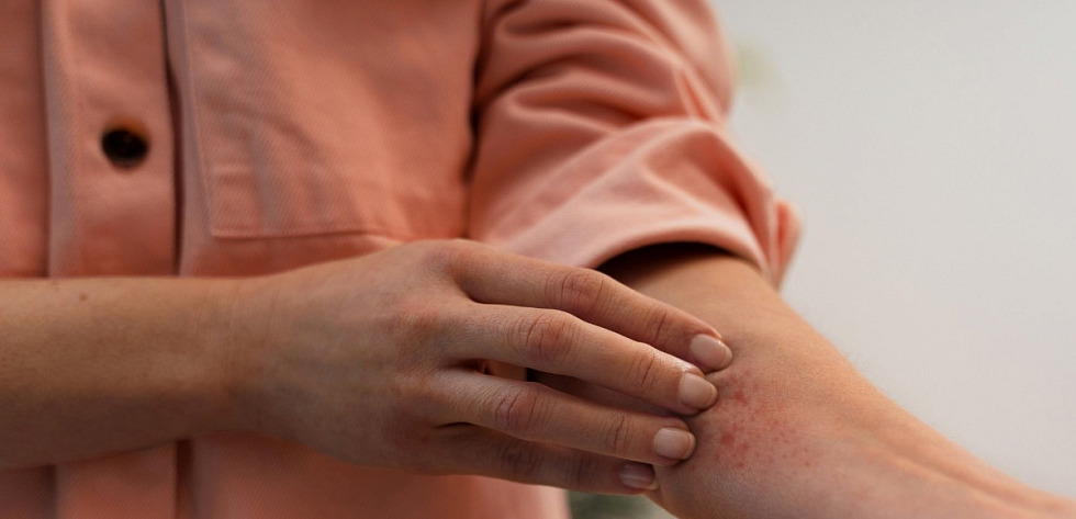 Co stosować przy alergii skórnej